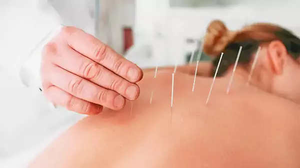 Acupuncture