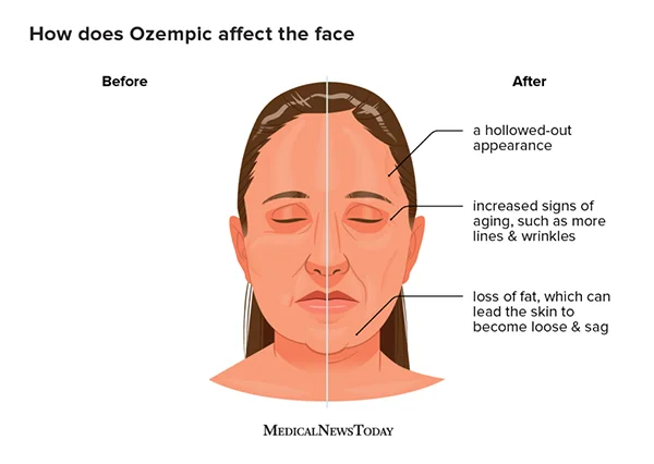  Ozempic side effects on face